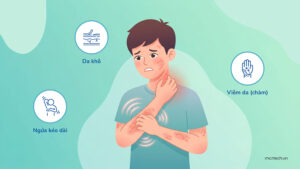 atopic dermatitis
